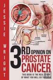 3rd Opinion On Prostate Cancer