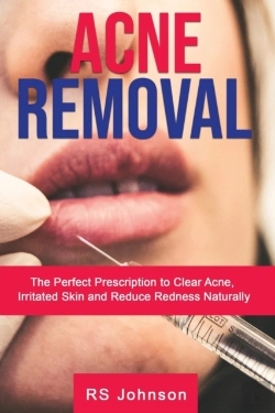 Bertrand.pt - Acne Removal