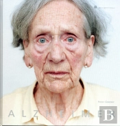 Alzheimer