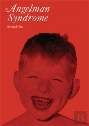 Angelman Syndrome