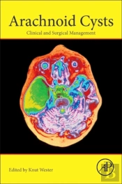 Arachnoid Cysts