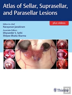 Bertrand.pt - Atlas Of Sellar, Suprasellar, And Parasellar Lesions