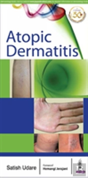 Atopic Dermatitis