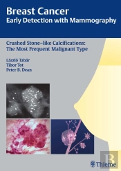 Breast Cancer: Early Detection With Mammography