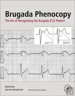 Bertrand.pt - Brugada Phenocopy