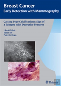Bertrand.pt - Casting-Type Calcifications: Sign Of A Subtype With Deceptive Features