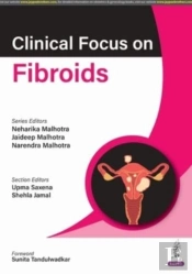 Clinical Focus On Fibroids