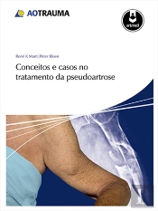Conceitos e Casos no Tratamento da Pseudoartrose
