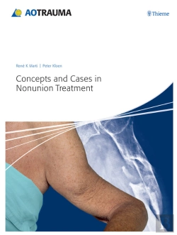 Bertrand.pt - Concepts And Cases In Nonunion Treatment