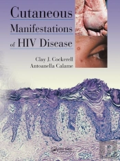 Cutaneous Manifestations Of Hiv Disease