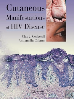 Bertrand.pt - Cutaneous Manifestations Of Hiv Disease