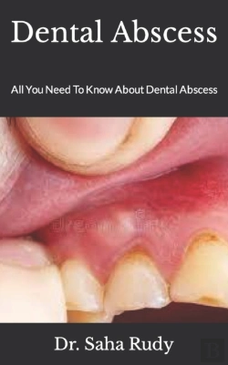 Bertrand.pt - Dental Abscess