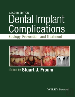 Bertrand.pt - Dental Implant Complications