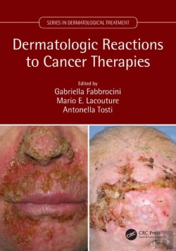 Bertrand.pt - Dermatologic Reactions To Cancer Therapies