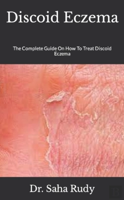 Bertrand.pt - Discoid Eczema