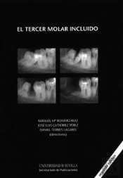 El Tercer Molar Incluido