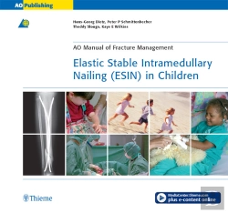 Bertrand.pt - Elastic Stable Intramedullary Nailing (Esin) In Children