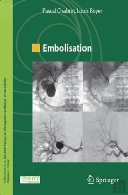 Bertrand.pt - Embolisation