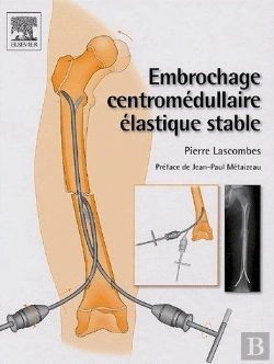 Bertrand.pt - Embrochage Centromédullaire Élastique Stable