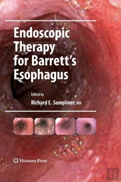Bertrand.pt - Endoscopic Therapy For Barrett'S Esophagus