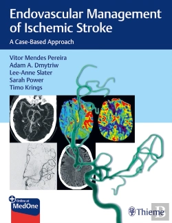 Bertrand.pt - Endovascular Management Of Ischemic Stroke