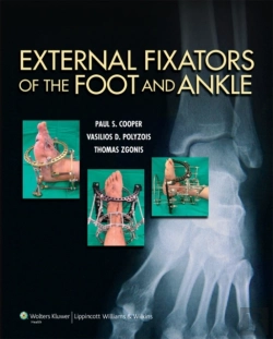 Bertrand.pt - External Fixators Of The Foot And Ankle