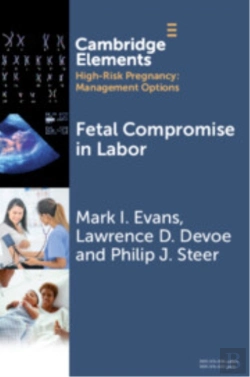 Bertrand.pt - Fetal Compromise In Labor