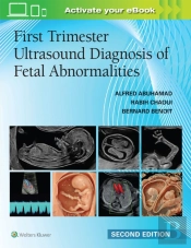 First Trimester Ultrasound Diagnosis Of Fetal Abnormalities
