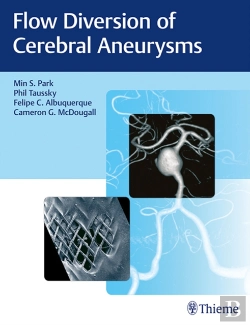 Bertrand.pt - Flow Diversion Of Cerebral Aneurysms