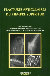 Fractures Articulaires Du Membre Supérieur