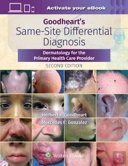 Bertrand.pt - Goodheart'S Same-Site Differential Diagnosis