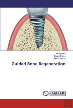 Bertrand.pt - Guided Bone Regeneration