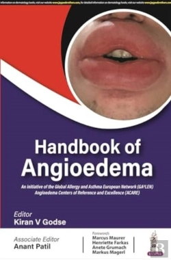 Bertrand.pt - Handbook Of Angioedema