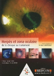 Herpes Et Zona Oculaire : De La Clinique Au Traitement