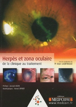 Bertrand.pt - Herpes Et Zona Oculaire : De La Clinique Au Traitement