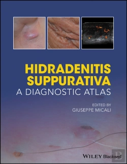 Bertrand.pt - Hidradenitis Suppurativa: A Diagnostic Atlas