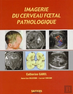 Bertrand.pt - Imagerie Du Cerveau Foetal Pathologique