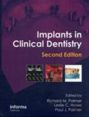 Implants In Clinical Dentistry