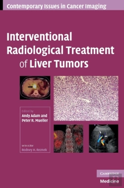 Bertrand.pt - Interventional Radiological Treatment Of Liver Tumors