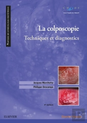 La Colposcopie