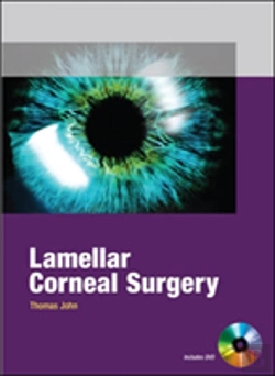 Bertrand.pt - Lamellar Corneal Surgery