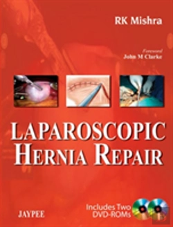 Bertrand.pt - Laparoscopic Hernia Repair