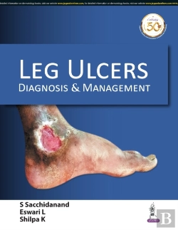 Bertrand.pt - Leg Ulcers