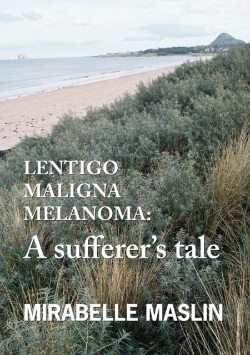 Bertrand.pt - Lentigo Maligna Melanoma
