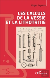 Les Calculs De La Vessie Et La Lithotritie