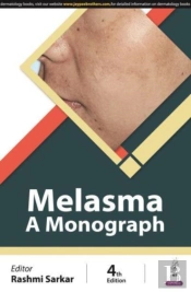 Melasma