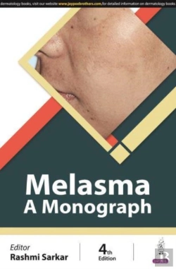 Bertrand.pt - Melasma