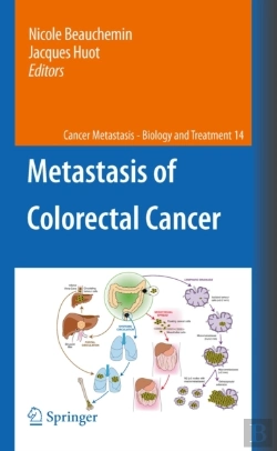 Bertrand.pt - Metastasis Of Colorectal Cancer