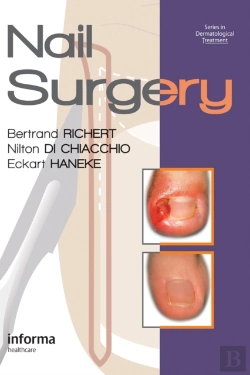 Bertrand.pt - Nail Surgery
