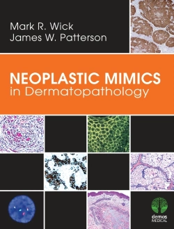 Bertrand.pt - Neoplastic Mimics In Dermatopathology